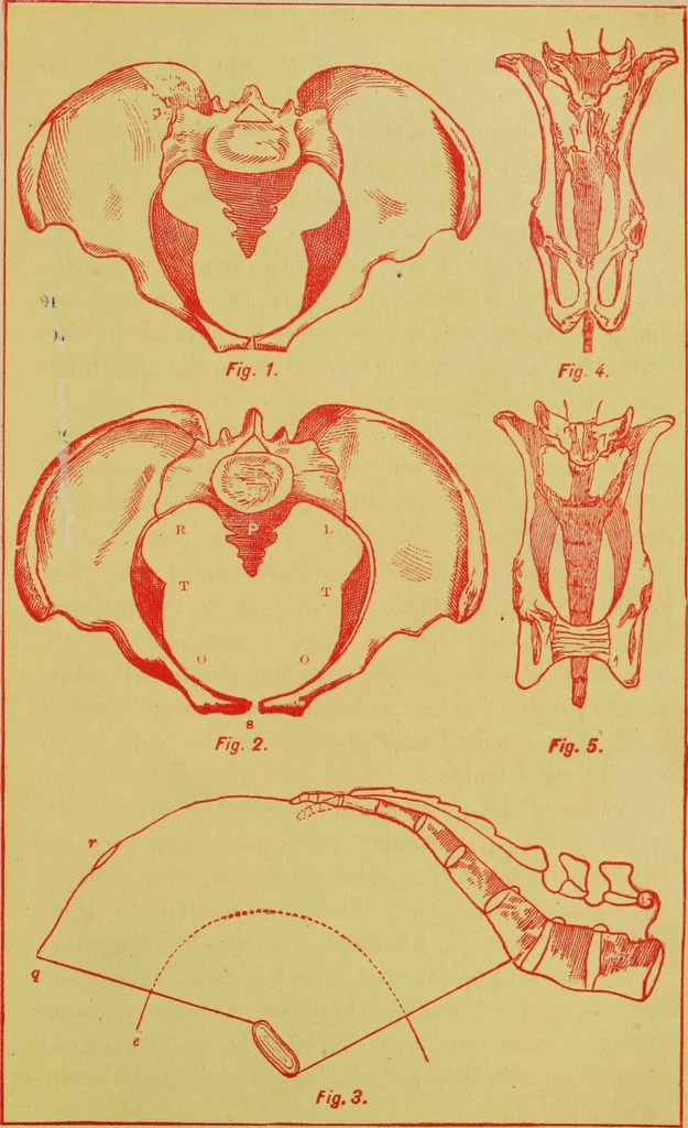 An illustration from Ladies' guide in health and disease : girlhood, maidenhood, wifehood, motherhood / by J.H. Kellogg., 1892, leaf 66
