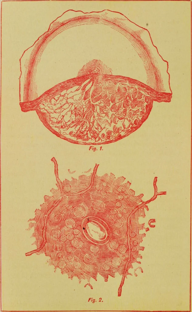 An illustration from Ladies' guide in health and disease : girlhood, maidenhood, wifehood, motherhood / by J.H. Kellogg., 1892, leaf 73