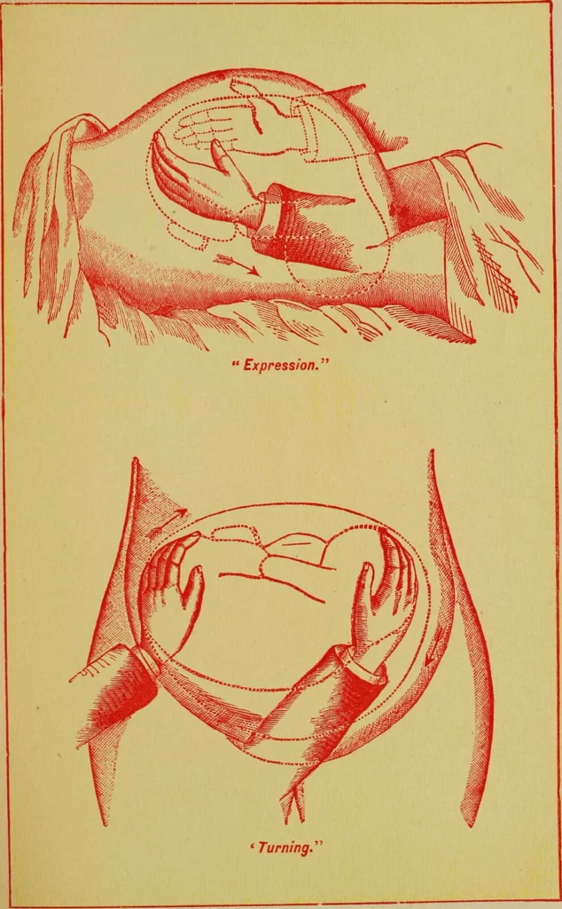 An illustration from Ladies' guide in health and disease : girlhood, maidenhood, wifehood, motherhood / by J.H. Kellogg., 1892, leaf 746