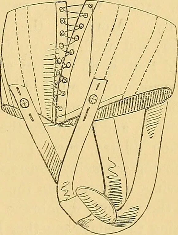 An illustration from On some diseases of women admitting of surgical treatment / by Isaac Baker Brown ; illustrated by coloured plates and wood engravings., 1854, leaf 113