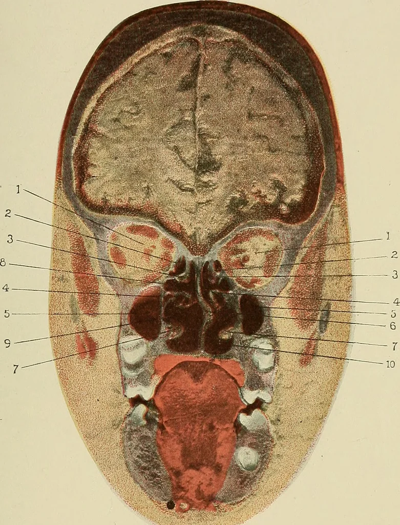 An illustration from Diseases of the nose and throat / by J. Price-Brown ; ill. with 159 engravings, including 6 full-page color-plates and 9 color-cuts in the text, many of them original., 1900, leaf 101