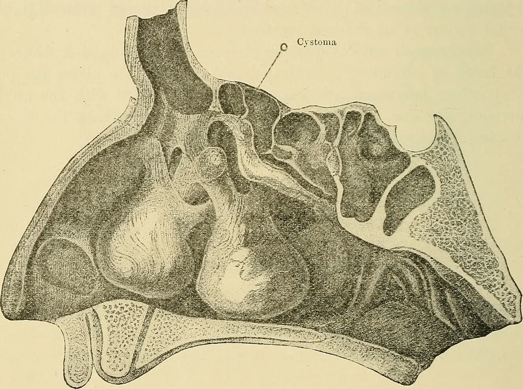 An illustration from Diseases of the nose and throat / by J. Price-Brown ; ill. with 159 engravings, including 6 full-page color-plates and 9 color-cuts in the text, many of them original., 1900, leaf 140