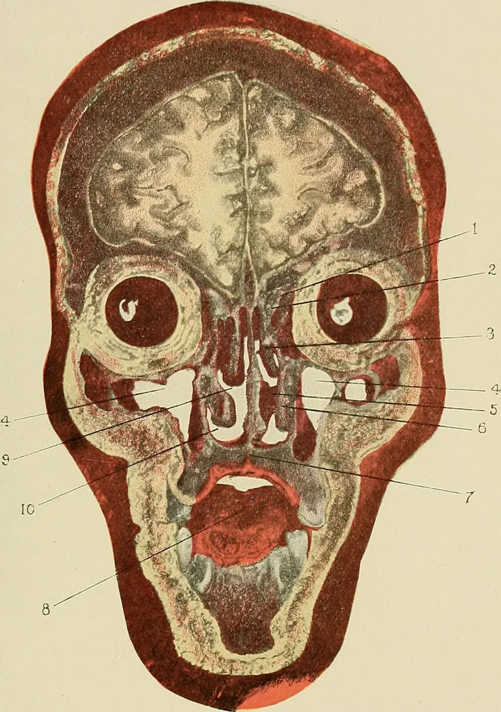 An illustration from Diseases of the nose and throat / by J. Price-Brown ; ill. with 159 engravings, including 6 full-page color-plates and 9 color-cuts in the text, many of them original., 1900, leaf 187