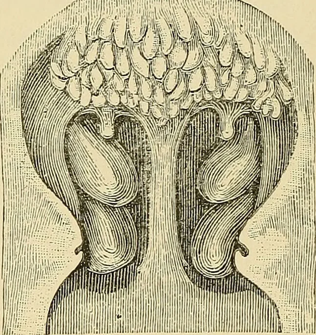 An illustration from Diseases of the nose and throat / by J. Price-Brown ; ill. with 159 engravings, including 6 full-page color-plates and 9 color-cuts in the text, many of them original., 1900, leaf 228