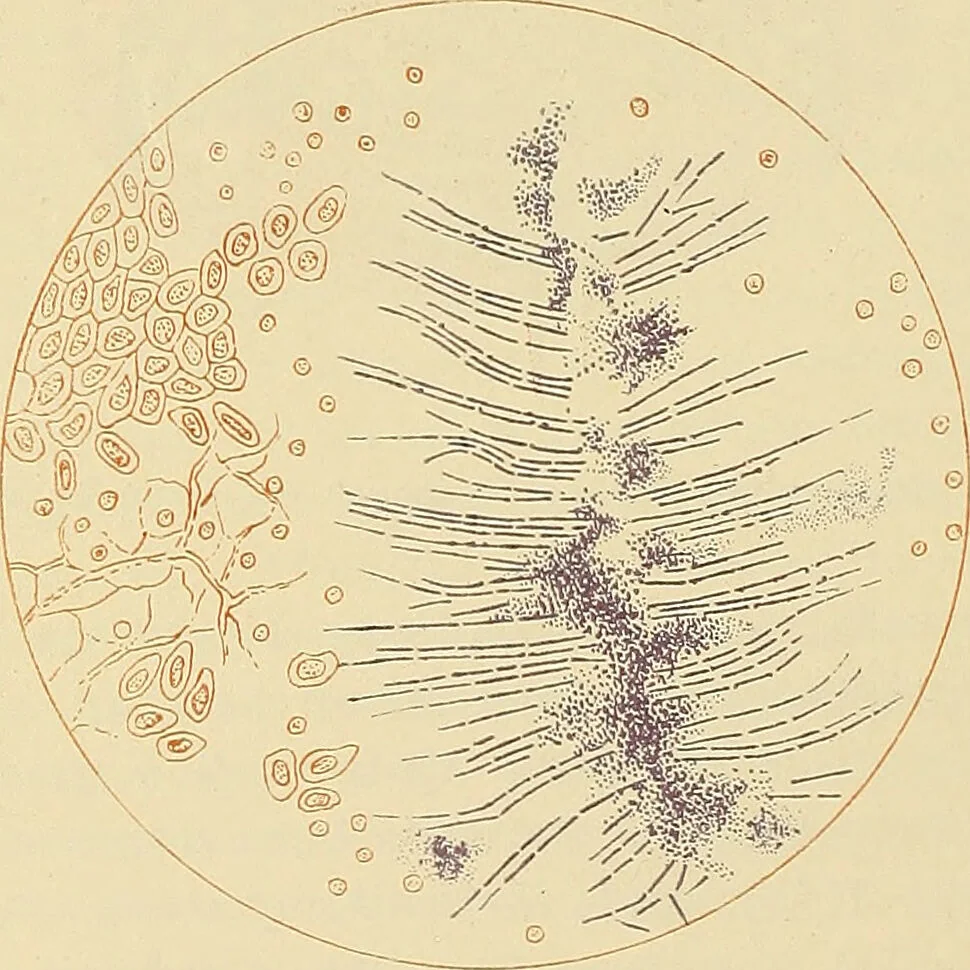 An illustration from Diseases of the nose and throat / by J. Price-Brown ; ill. with 159 engravings, including 6 full-page color-plates and 9 color-cuts in the text, many of them original., 1900, leaf 302