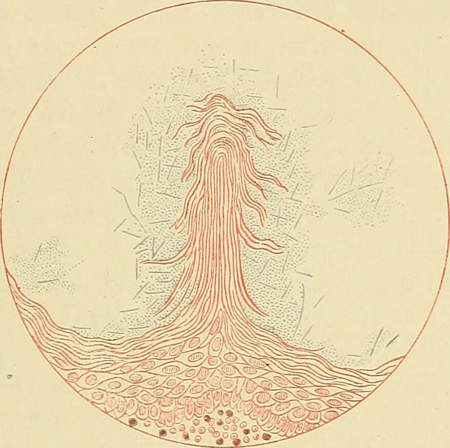 An illustration from Diseases of the nose and throat / by J. Price-Brown ; ill. with 159 engravings, including 6 full-page color-plates and 9 color-cuts in the text, many of them original., 1900, leaf 303