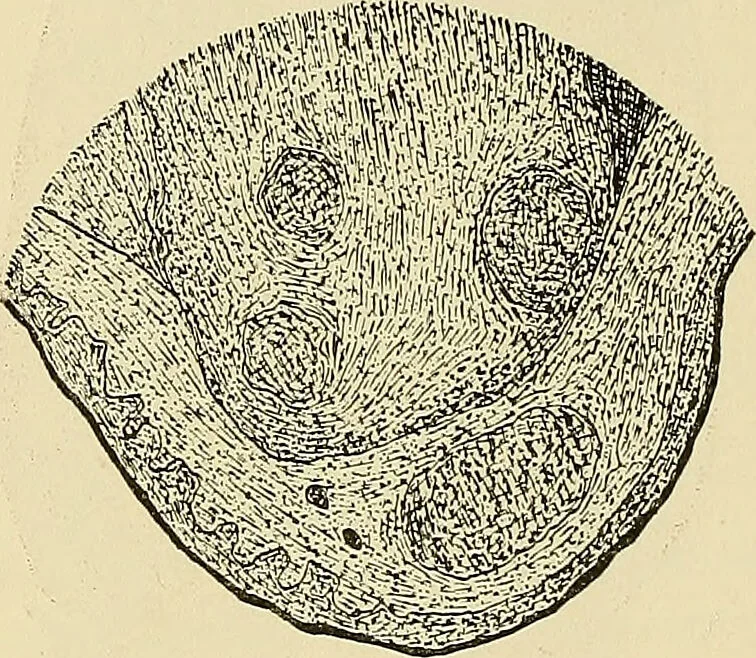 An illustration from Diseases of the nose and throat / by J. Price-Brown ; ill. with 159 engravings, including 6 full-page color-plates and 9 color-cuts in the text, many of them original., 1900, leaf 310