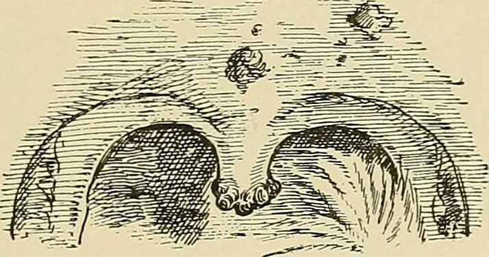 An illustration from Diseases of the nose and throat / by J. Price-Brown ; ill. with 159 engravings, including 6 full-page color-plates and 9 color-cuts in the text, many of them original., 1900, leaf 321