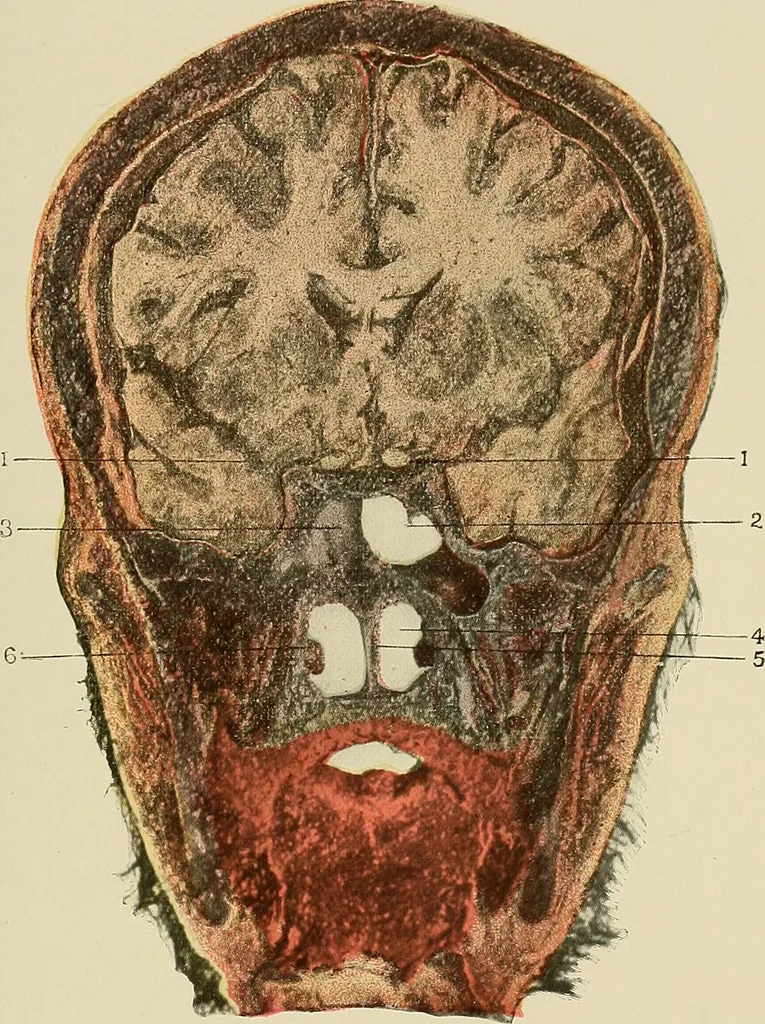 An illustration from Diseases of the nose and throat / by J. Price-Brown ; ill. with 159 engravings, including 6 full-page color-plates and 9 color-cuts in the text, many of them original., 1900, leaf 33