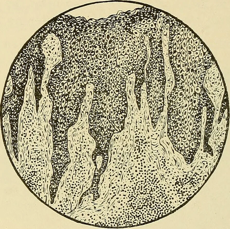 An illustration from Diseases of the nose and throat / by J. Price-Brown ; ill. with 159 engravings, including 6 full-page color-plates and 9 color-cuts in the text, many of them original., 1900, leaf 336