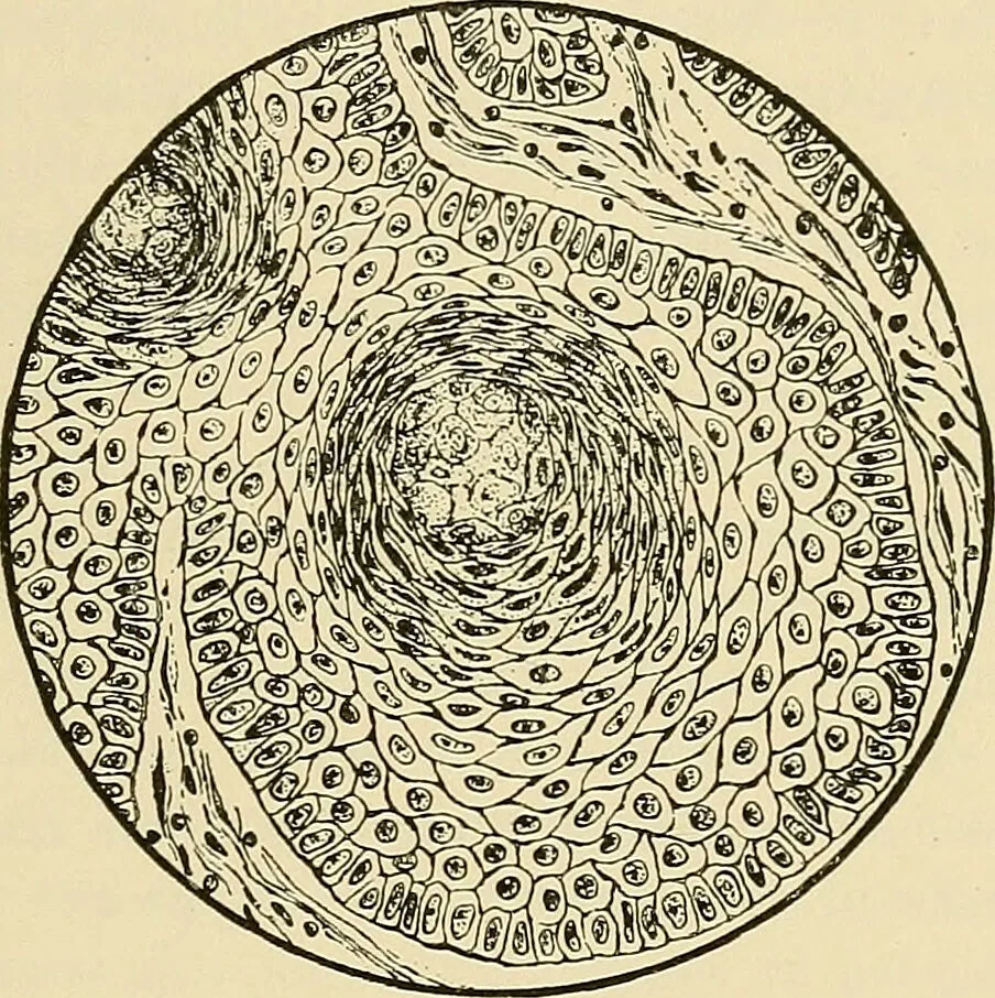 An illustration from Diseases of the nose and throat / by J. Price-Brown ; ill. with 159 engravings, including 6 full-page color-plates and 9 color-cuts in the text, many of them original., 1900, leaf 337