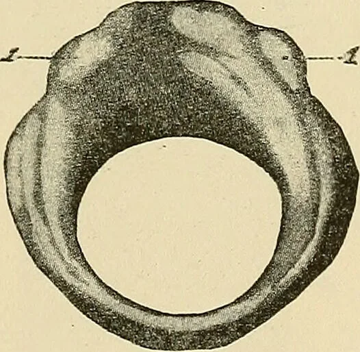 An illustration from Diseases of the nose and throat / by J. Price-Brown ; ill. with 159 engravings, including 6 full-page color-plates and 9 color-cuts in the text, many of them original., 1900, leaf 353
