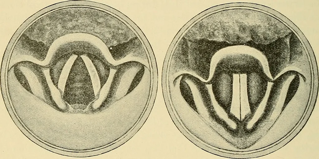 An illustration from Diseases of the nose and throat / by J. Price-Brown ; ill. with 159 engravings, including 6 full-page color-plates and 9 color-cuts in the text, many of them original., 1900, leaf 362