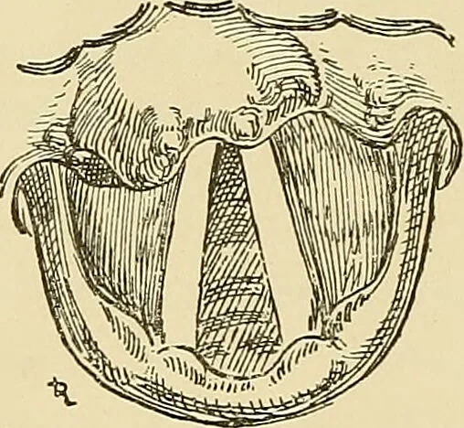 An illustration from Diseases of the nose and throat / by J. Price-Brown ; ill. with 159 engravings, including 6 full-page color-plates and 9 color-cuts in the text, many of them original., 1900, leaf 430
