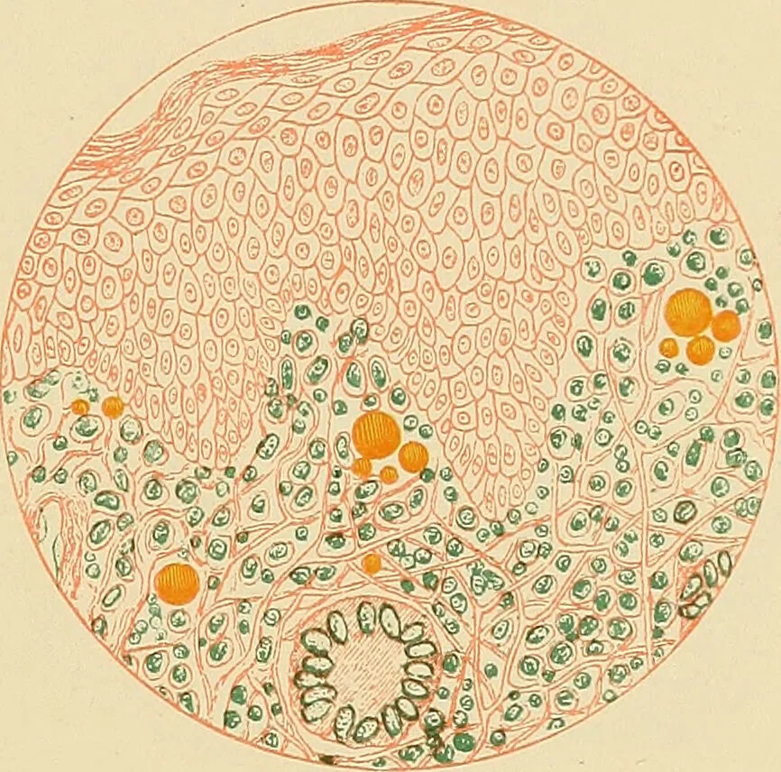 An illustration from Diseases of the nose and throat / by J. Price-Brown ; ill. with 159 engravings, including 6 full-page color-plates and 9 color-cuts in the text, many of them original., 1900, leaf 431