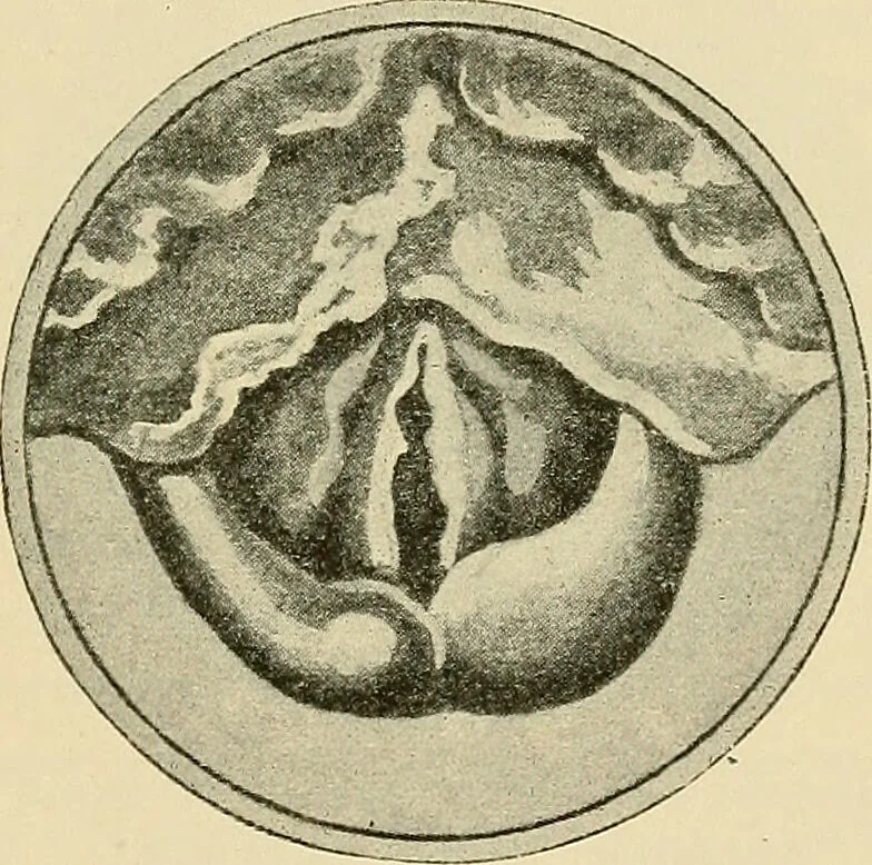 An illustration from Diseases of the nose and throat / by J. Price-Brown ; ill. with 159 engravings, including 6 full-page color-plates and 9 color-cuts in the text, many of them original., 1900, leaf 439