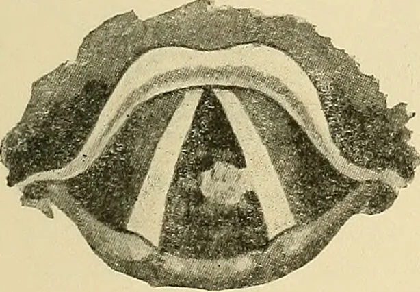 An illustration from Diseases of the nose and throat / by J. Price-Brown ; ill. with 159 engravings, including 6 full-page color-plates and 9 color-cuts in the text, many of them original., 1900, leaf 453