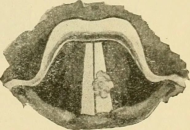 An illustration from Diseases of the nose and throat / by J. Price-Brown ; ill. with 159 engravings, including 6 full-page color-plates and 9 color-cuts in the text, many of them original., 1900, leaf 453