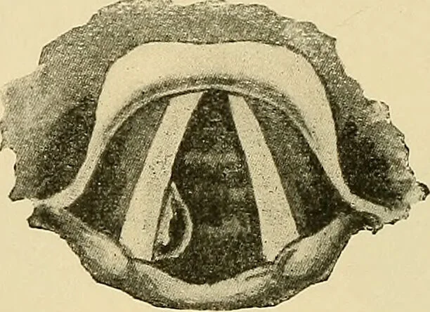 An illustration from Diseases of the nose and throat / by J. Price-Brown ; ill. with 159 engravings, including 6 full-page color-plates and 9 color-cuts in the text, many of them original., 1900, leaf 454