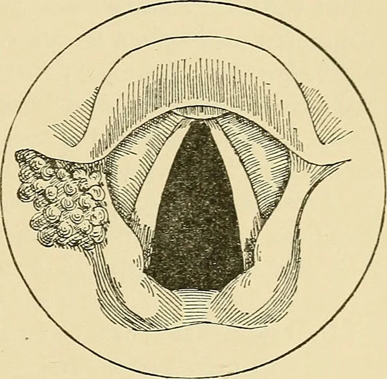 An illustration from Diseases of the nose and throat / by J. Price-Brown ; ill. with 159 engravings, including 6 full-page color-plates and 9 color-cuts in the text, many of them original., 1900, leaf 455