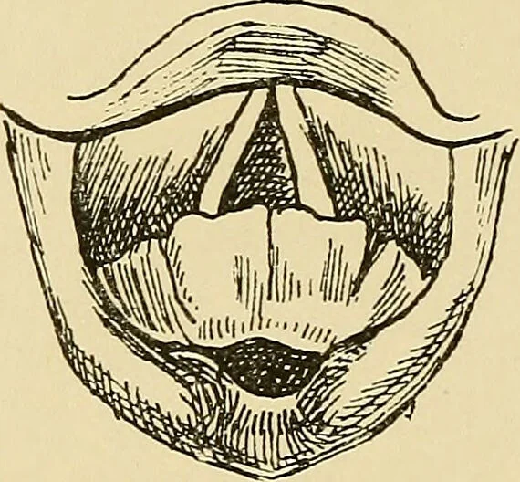 An illustration from Diseases of the nose and throat / by J. Price-Brown ; ill. with 159 engravings, including 6 full-page color-plates and 9 color-cuts in the text, many of them original., 1900, leaf 466