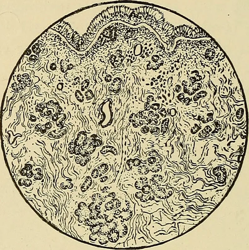 An illustration from Diseases of the nose and throat / by J. Price-Brown ; ill. with 159 engravings, including 6 full-page color-plates and 9 color-cuts in the text, many of them original., 1900, leaf 72