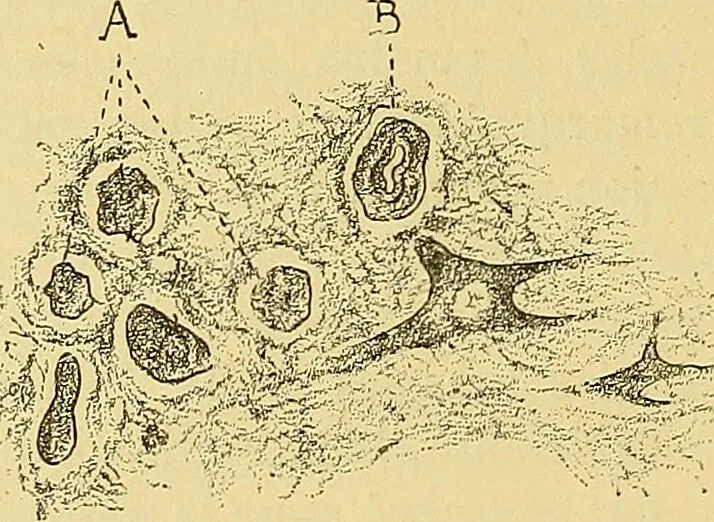 An illustration from Contribution à l'étude de l'atrophie musculaire progressive, type Duchenne-Aran / par le Dr. J. -B. Charcot., 1895, leaf 132