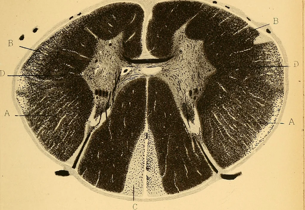 An illustration from Contribution à l'étude de l'atrophie musculaire progressive, type Duchenne-Aran / par le Dr. J. -B. Charcot., 1895, leaf 173