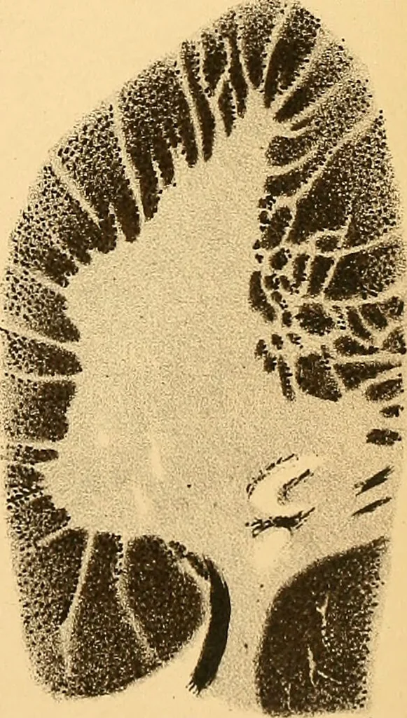 An illustration from Contribution à l'étude de l'atrophie musculaire progressive, type Duchenne-Aran / par le Dr. J. -B. Charcot., 1895, leaf 173