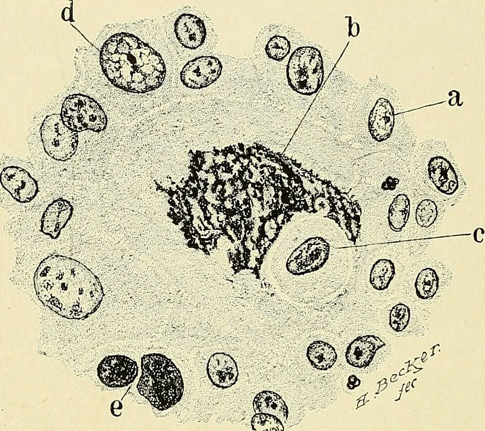 An illustration from Cancer of the uterus : its pathology, symptomatology, diagnosis, and treatment : also the pathology of diseases of the endometrium / by Thomas Stephen Cullen ; with eleven lithographic plates and over three hundred coloured and black illustrations in the text by May Brödel and Hermann Becker., 1900, leaf 128