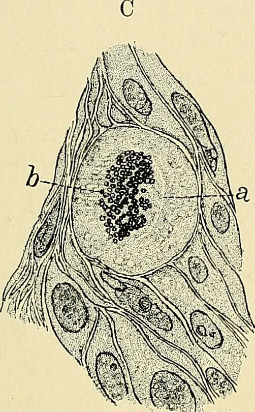 An illustration from Cancer of the uterus : its pathology, symptomatology, diagnosis, and treatment : also the pathology of diseases of the endometrium / by Thomas Stephen Cullen ; with eleven lithographic plates and over three hundred coloured and black illustrations in the text by May Brödel and Hermann Becker., 1900, leaf 131