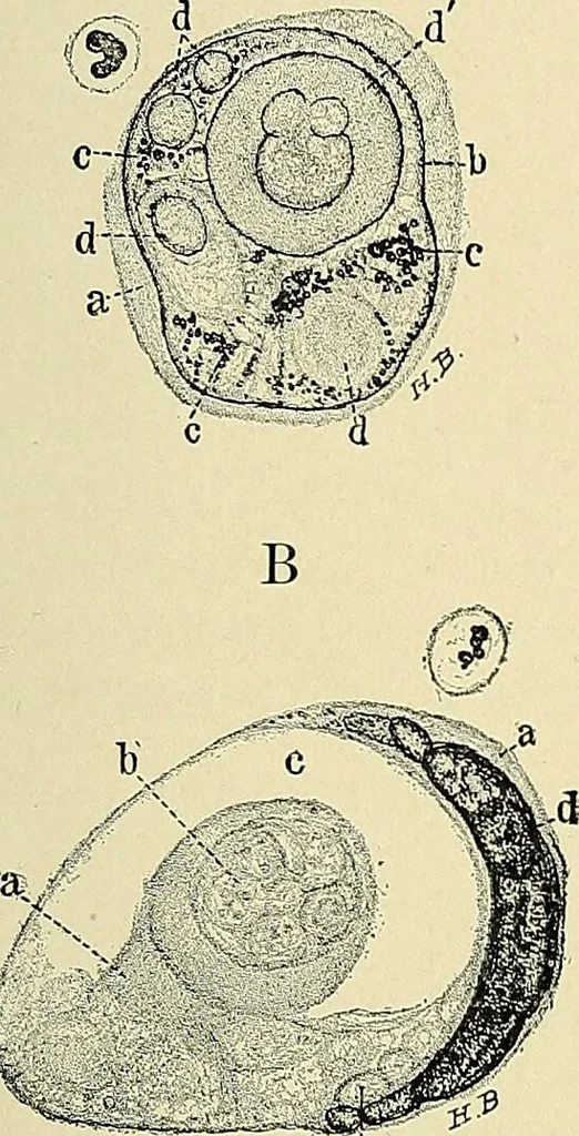 An illustration from Cancer of the uterus : its pathology, symptomatology, diagnosis, and treatment : also the pathology of diseases of the endometrium / by Thomas Stephen Cullen ; with eleven lithographic plates and over three hundred coloured and black illustrations in the text by May Brödel and Hermann Becker., 1900, leaf 177