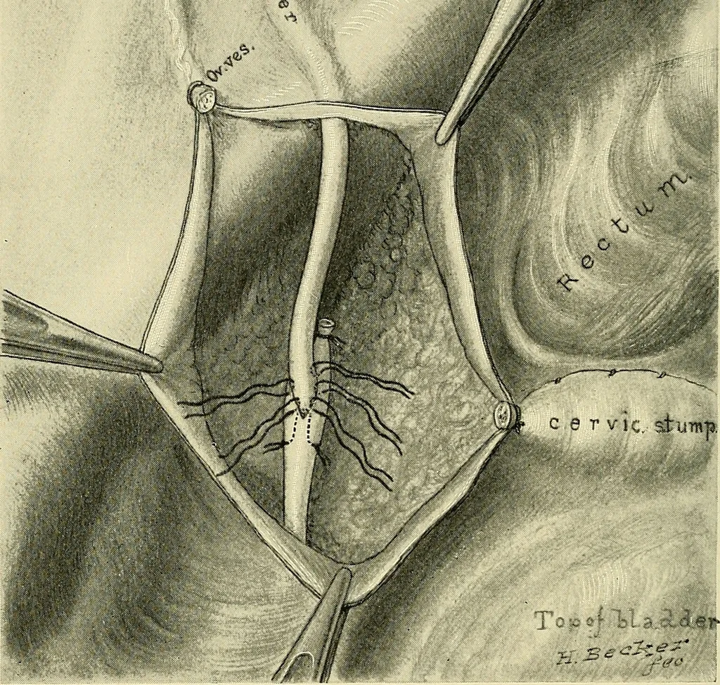 An illustration from Cancer of the uterus : its pathology, symptomatology, diagnosis, and treatment : also the pathology of diseases of the endometrium / by Thomas Stephen Cullen ; with eleven lithographic plates and over three hundred coloured and black illustrations in the text by May Brödel and Hermann Becker., 1900, leaf 300