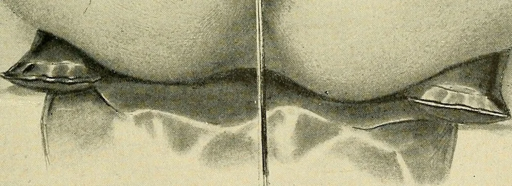 An illustration from Cancer of the uterus : its pathology, symptomatology, diagnosis, and treatment : also the pathology of diseases of the endometrium / by Thomas Stephen Cullen ; with eleven lithographic plates and over three hundred coloured and black illustrations in the text by May Brödel and Hermann Becker., 1900, leaf 307