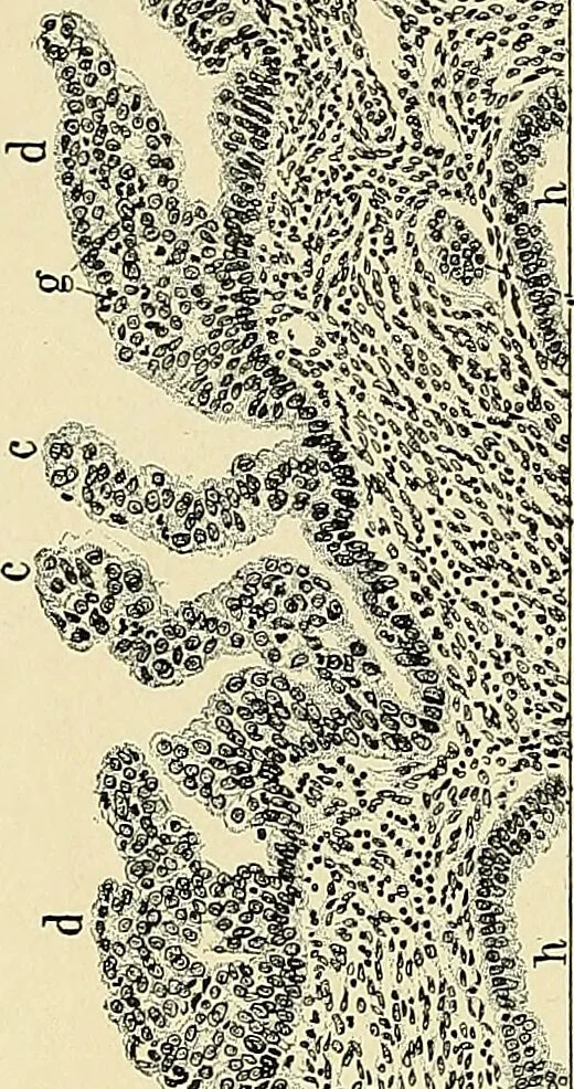 An illustration from Cancer of the uterus : its pathology, symptomatology, diagnosis, and treatment : also the pathology of diseases of the endometrium / by Thomas Stephen Cullen ; with eleven lithographic plates and over three hundred coloured and black illustrations in the text by May Brödel and Hermann Becker., 1900, leaf 376