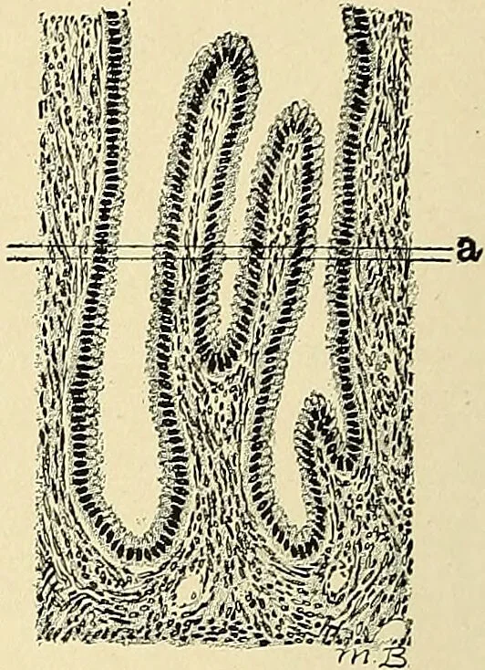 An illustration from Cancer of the uterus : its pathology, symptomatology, diagnosis, and treatment : also the pathology of diseases of the endometrium / by Thomas Stephen Cullen ; with eleven lithographic plates and over three hundred coloured and black illustrations in the text by May Brödel and Hermann Becker., 1900, leaf 46