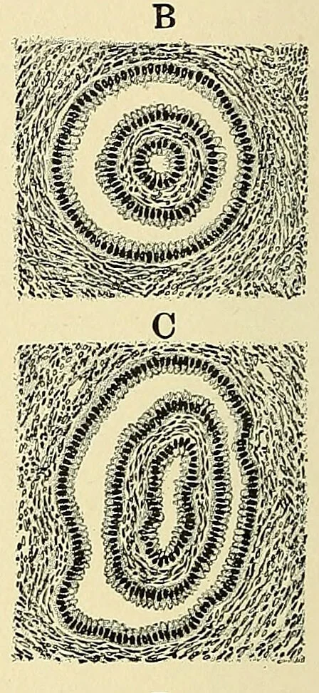 An illustration from Cancer of the uterus : its pathology, symptomatology, diagnosis, and treatment : also the pathology of diseases of the endometrium / by Thomas Stephen Cullen ; with eleven lithographic plates and over three hundred coloured and black illustrations in the text by May Brödel and Hermann Becker., 1900, leaf 46
