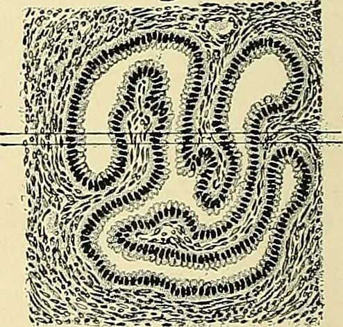 An illustration from Cancer of the uterus : its pathology, symptomatology, diagnosis, and treatment : also the pathology of diseases of the endometrium / by Thomas Stephen Cullen ; with eleven lithographic plates and over three hundred coloured and black illustrations in the text by May Brödel and Hermann Becker., 1900, leaf 46
