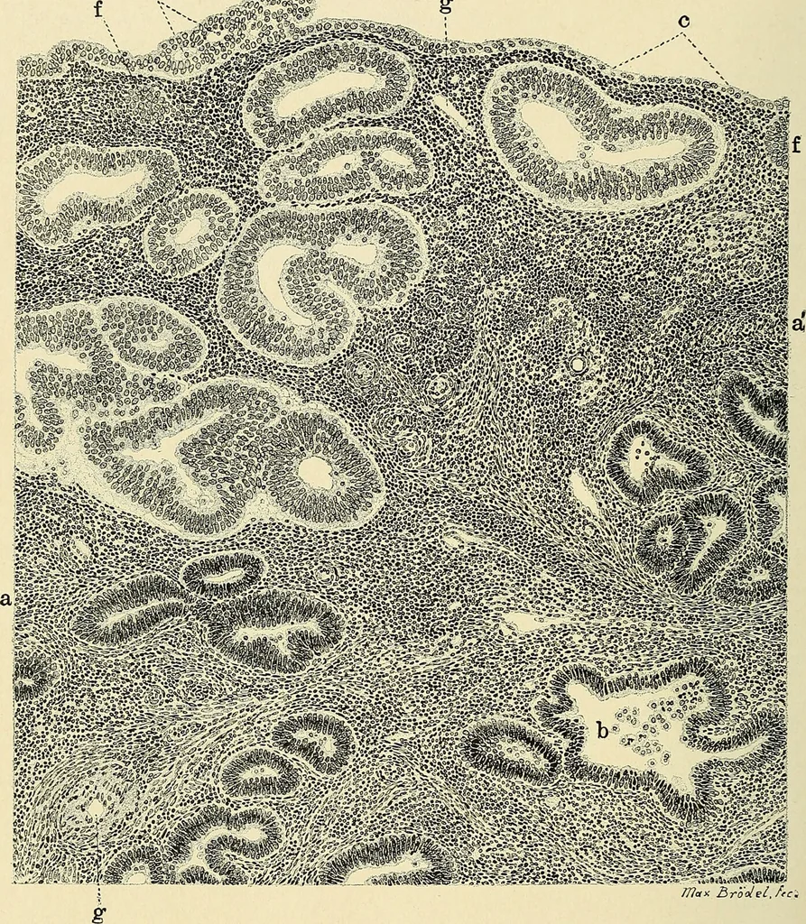 An illustration from Cancer of the uterus : its pathology, symptomatology, diagnosis, and treatment : also the pathology of diseases of the endometrium / by Thomas Stephen Cullen ; with eleven lithographic plates and over three hundred coloured and black illustrations in the text by May Brödel and Hermann Becker., 1900, leaf 462