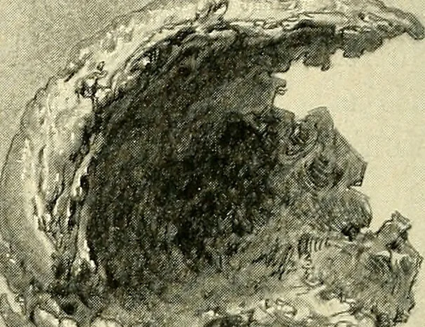 An illustration from Cancer of the uterus : its pathology, symptomatology, diagnosis, and treatment : also the pathology of diseases of the endometrium / by Thomas Stephen Cullen ; with eleven lithographic plates and over three hundred coloured and black illustrations in the text by May Brödel and Hermann Becker., 1900, leaf 470