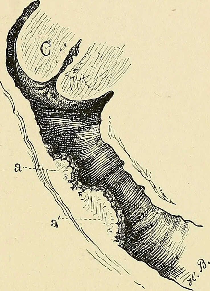 An illustration from Cancer of the uterus : its pathology, symptomatology, diagnosis, and treatment : also the pathology of diseases of the endometrium / by Thomas Stephen Cullen ; with eleven lithographic plates and over three hundred coloured and black illustrations in the text by May Brödel and Hermann Becker., 1900, leaf 475
