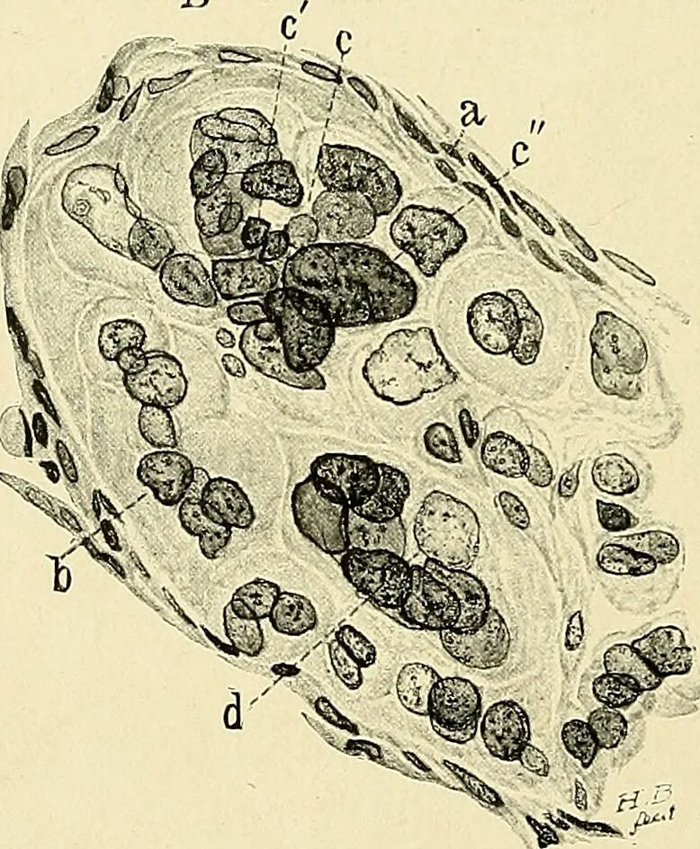 An illustration from Cancer of the uterus : its pathology, symptomatology, diagnosis, and treatment : also the pathology of diseases of the endometrium / by Thomas Stephen Cullen ; with eleven lithographic plates and over three hundred coloured and black illustrations in the text by May Brödel and Hermann Becker., 1900, leaf 490