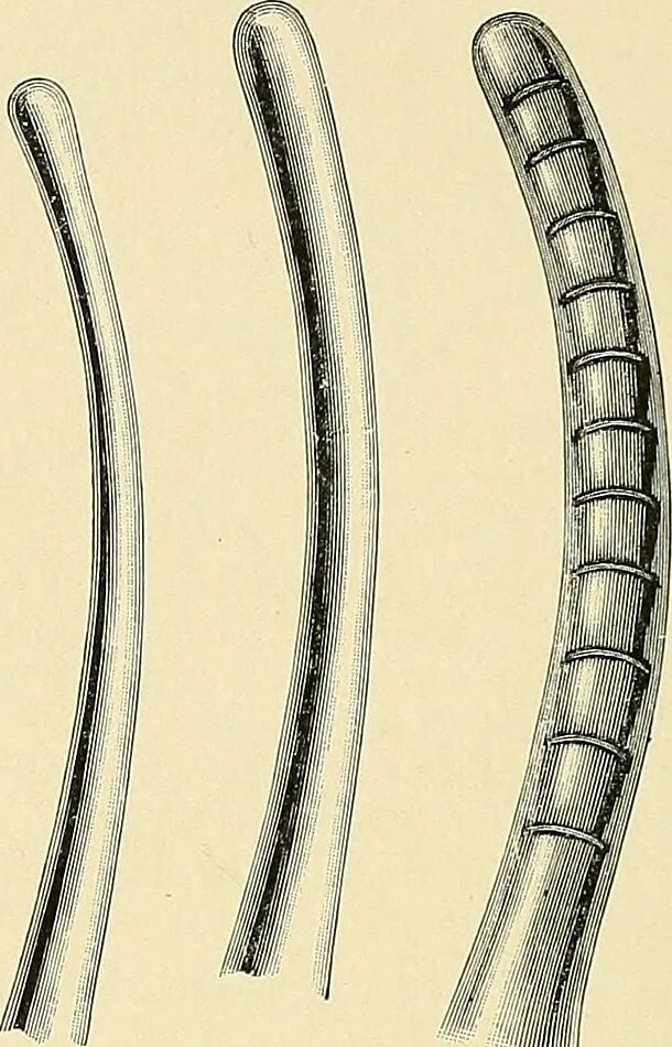 An illustration from Cancer of the uterus : its pathology, symptomatology, diagnosis, and treatment : also the pathology of diseases of the endometrium / by Thomas Stephen Cullen ; with eleven lithographic plates and over three hundred coloured and black illustrations in the text by May Brödel and Hermann Becker., 1900, leaf 50