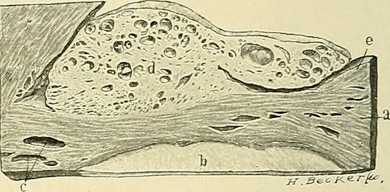 An illustration from Cancer of the uterus : its pathology, symptomatology, diagnosis, and treatment : also the pathology of diseases of the endometrium / by Thomas Stephen Cullen ; with eleven lithographic plates and over three hundred coloured and black illustrations in the text by May Brödel and Hermann Becker., 1900, leaf 544