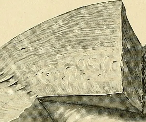 An illustration from Cancer of the uterus : its pathology, symptomatology, diagnosis, and treatment : also the pathology of diseases of the endometrium / by Thomas Stephen Cullen ; with eleven lithographic plates and over three hundred coloured and black illustrations in the text by May Brödel and Hermann Becker., 1900, leaf 597