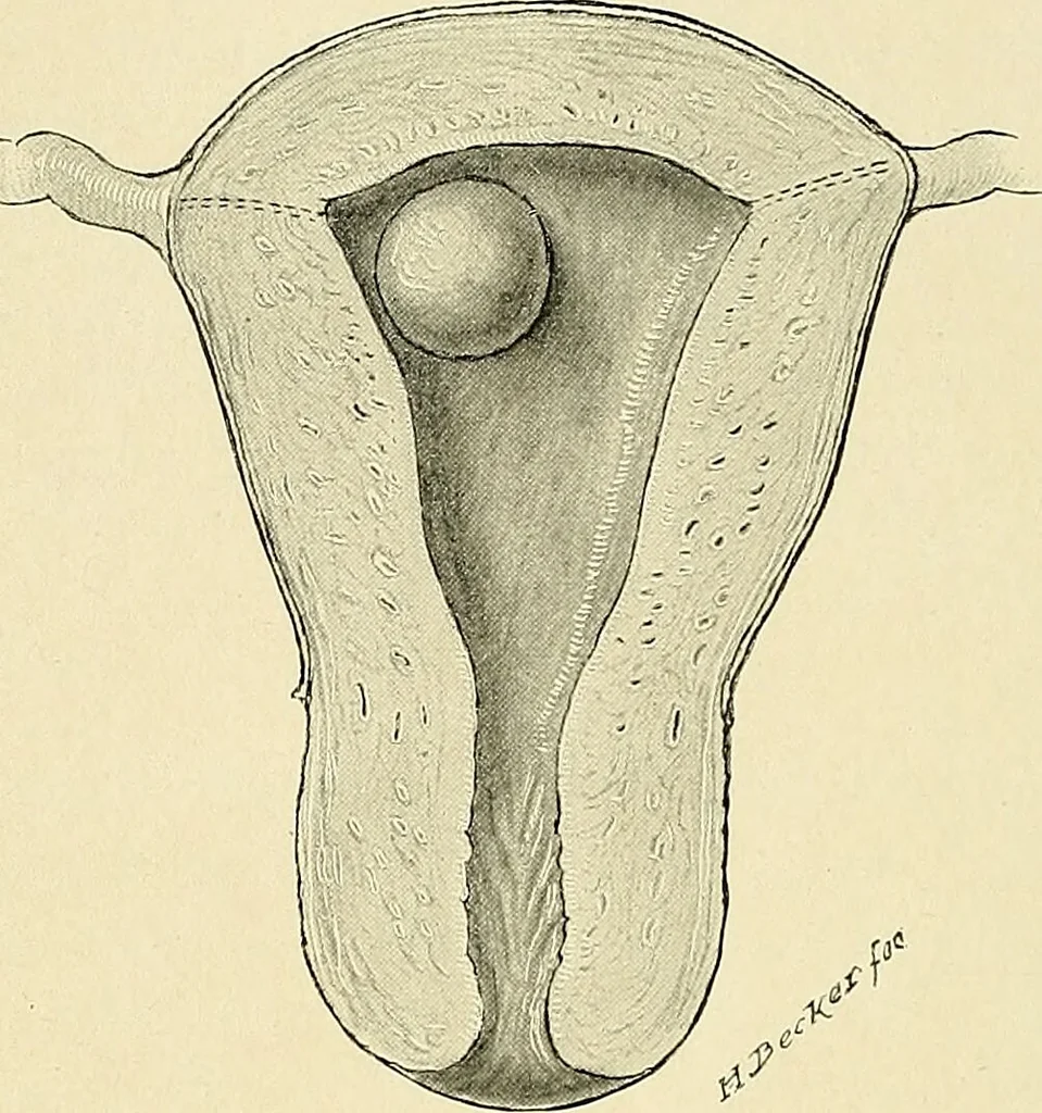 An illustration from Cancer of the uterus : its pathology, symptomatology, diagnosis, and treatment : also the pathology of diseases of the endometrium / by Thomas Stephen Cullen ; with eleven lithographic plates and over three hundred coloured and black illustrations in the text by May Brödel and Hermann Becker., 1900, leaf 612