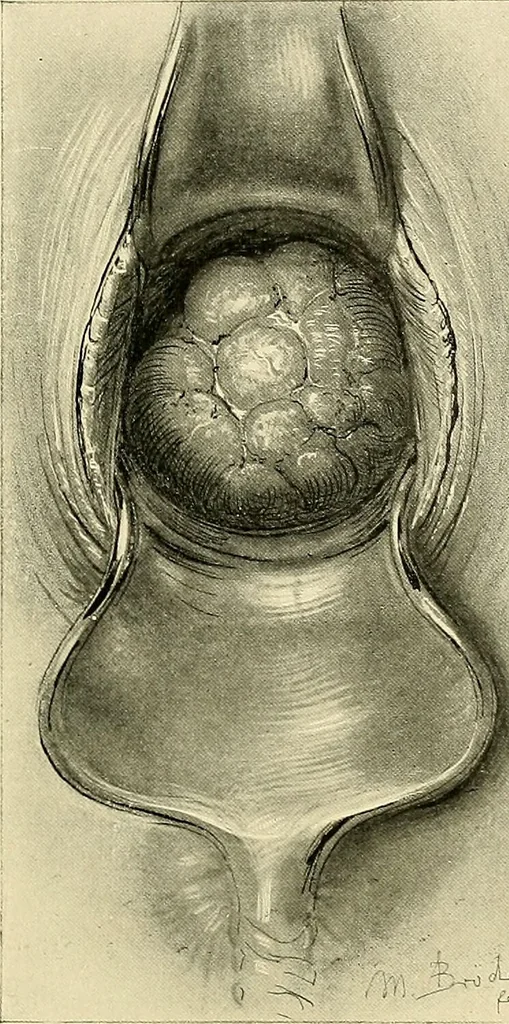 An illustration from Cancer of the uterus : its pathology, symptomatology, diagnosis, and treatment : also the pathology of diseases of the endometrium / by Thomas Stephen Cullen ; with eleven lithographic plates and over three hundred coloured and black illustrations in the text by May Brödel and Hermann Becker., 1900, leaf 621