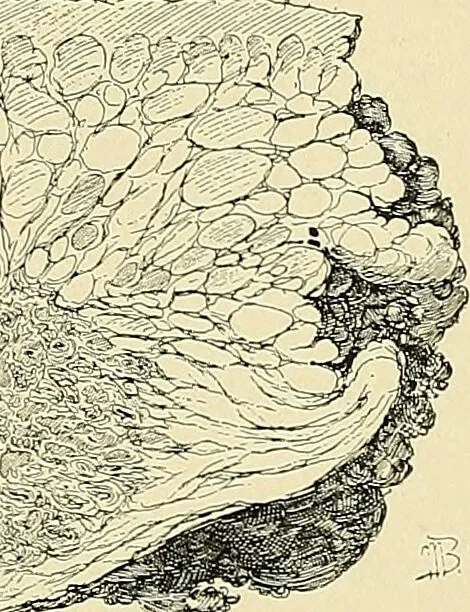 An illustration from Cancer of the uterus : its pathology, symptomatology, diagnosis, and treatment : also the pathology of diseases of the endometrium / by Thomas Stephen Cullen ; with eleven lithographic plates and over three hundred coloured and black illustrations in the text by May Brödel and Hermann Becker., 1900, leaf 643