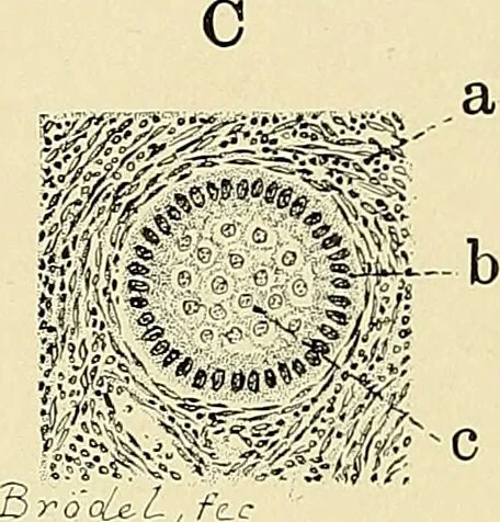 An illustration from Cancer of the uterus : its pathology, symptomatology, diagnosis, and treatment : also the pathology of diseases of the endometrium / by Thomas Stephen Cullen ; with eleven lithographic plates and over three hundred coloured and black illustrations in the text by May Brödel and Hermann Becker., 1900, leaf 74