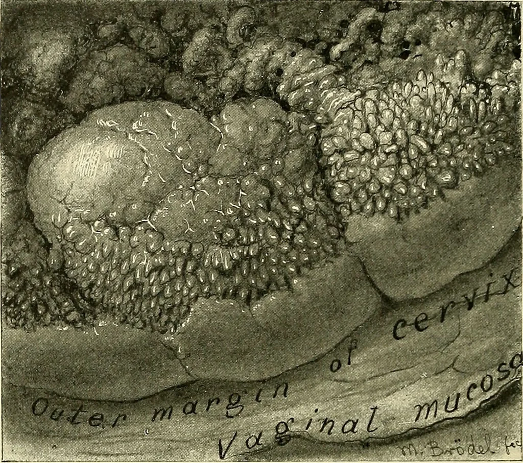 An illustration from Cancer of the uterus : its pathology, symptomatology, diagnosis, and treatment : also the pathology of diseases of the endometrium / by Thomas Stephen Cullen ; with eleven lithographic plates and over three hundred coloured and black illustrations in the text by May Brödel and Hermann Becker., 1900, leaf 80